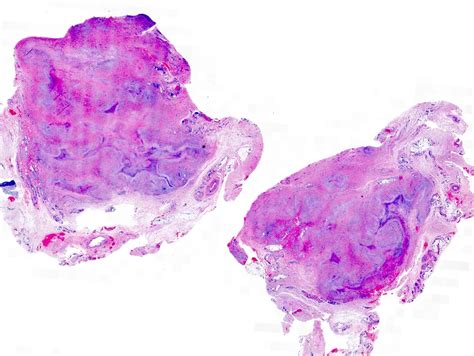 Pathology Outlines Rheumatoid Rheumatic Nodules