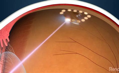Laser Retinopexy Freedom Eye Laser — Freedom Eye Laser