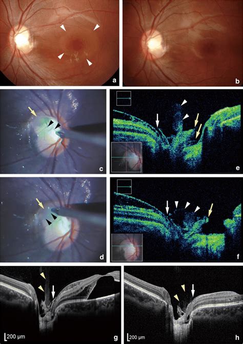 Preoperative Intraoperative And Postoperative Fundus Photographs And