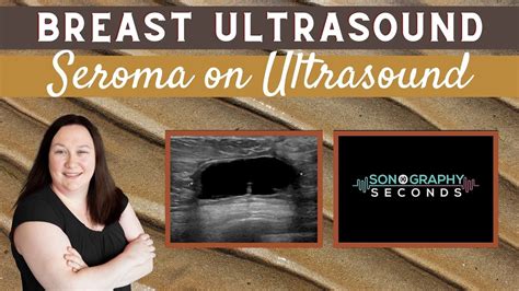 Breast Ultrasound Appearance Of A Seroma On Ultrasound Youtube