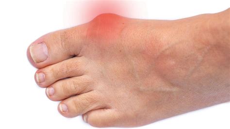 Bunions Surgery Treatment Symptoms And Causes The Feet People Podiatry
