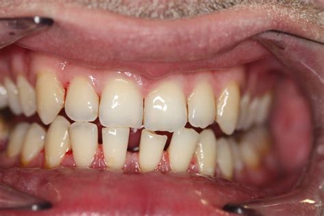How Do I Treat Gum Disease Periodontal Disease Treatment Herts Dental