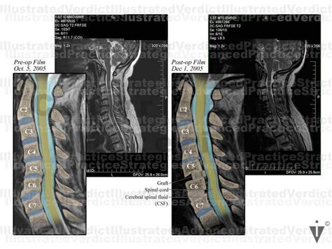 Stock Spine Cervical Spine — Illustrated Verdict