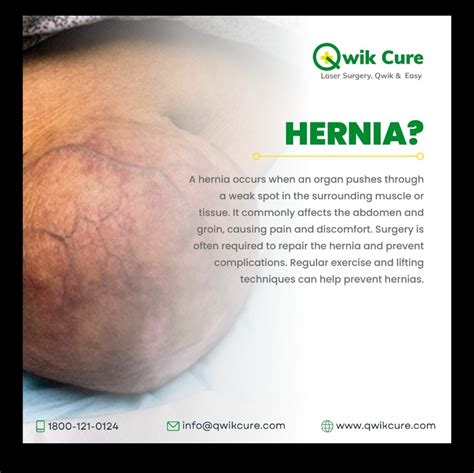 A Hernia Occurs When An Internal Organ Or Other Body Part Protrudes