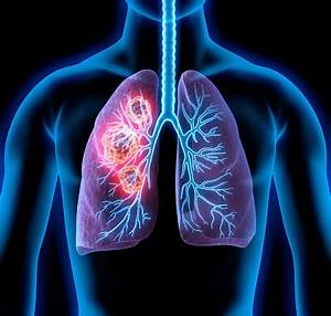 Lung Cancer Awareness Lung Cancer  