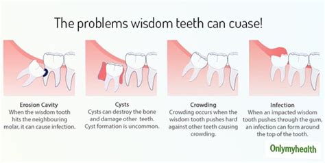 How To Ease Wisdom Tooth Pain Before Surgery Reverasite