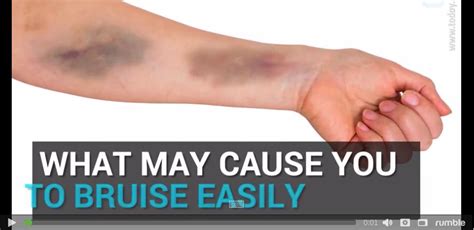 Do You Get Bruises Easily Here Are 7 Things That Might Be To Blame