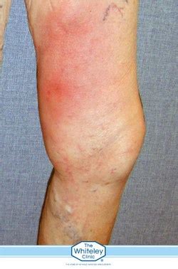 What Is Phlebitis The Whiteley Clinic