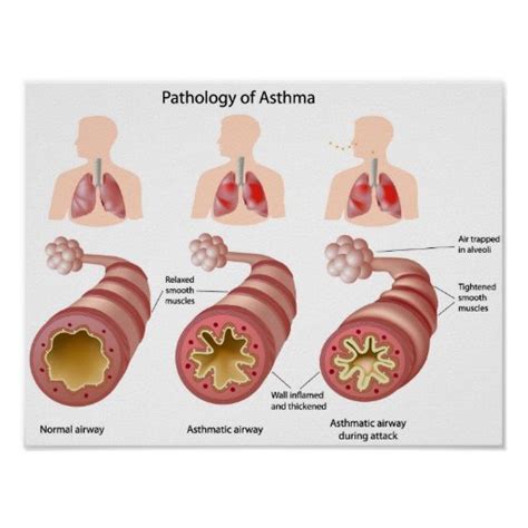 Is Asthma An Illness Or Disease
