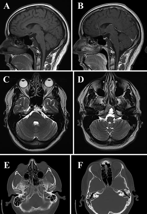 Benign Notochordal Cell Tumor Of The Clivus With Chordoma Component