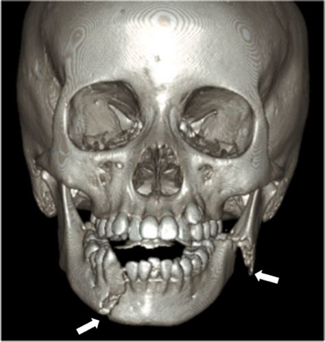 Three Dimensional Reconstruction Of Facial Ct Depicting Displaced Right