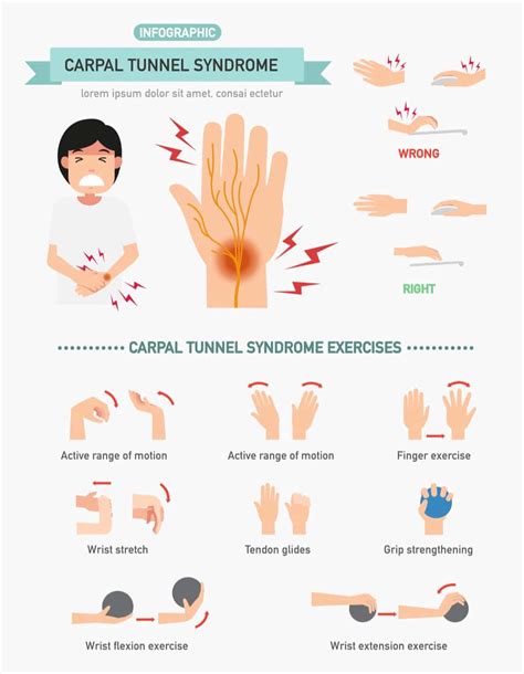 What Is Carpal Tunnel Syndrome Understanding And Treating Cts