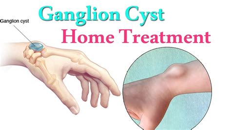 Ganglion Cyst Jaw