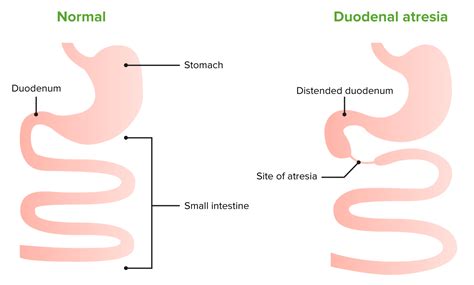 Angeborene Duodenale Obstruktion E Learning Mit Lecturio