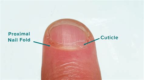 Proximal Nail Fold Pictures Function Care And Medical Concerns