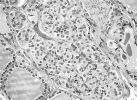 C Cell Hyperplasia And Medullary Thyroid Carcinoma Clinicopathological