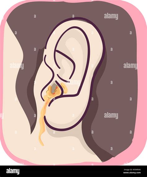 Illustration Of Fluid Leaking From Inside Ear From Infection Stock