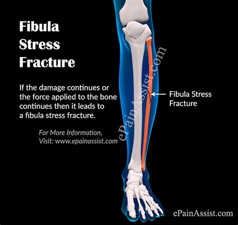 What Is Fibula Stress Fracturesymptomscausestreatmentdiagnosis