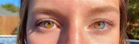I Have Partial Heterochromia In Both Eyes Rmildlyinteresting