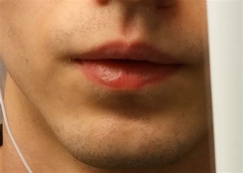 Why Is The Skin Around My Lips Whiterush