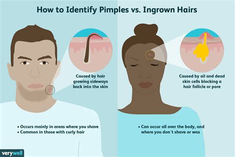 Ingrown Hair Vs Herpes