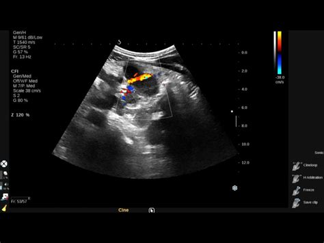 Vietnamese Medic Ultrasound Case Lymph Node Tuberculosis Dr Phan