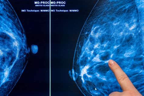 breast cancer screening how often should a woman get a mammogram vox