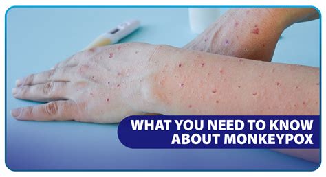 What You Need To Know About Monkeypox Unilab