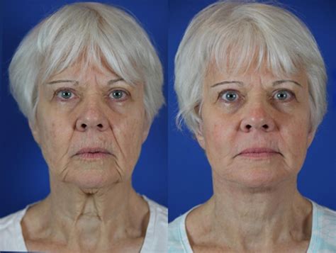Co2 Laser Skin Resurfacing Before And After Photos Patient 59 Brentwood