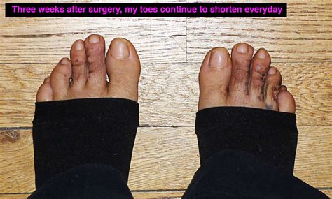 Hammertoe Repair Implant Jodie Call