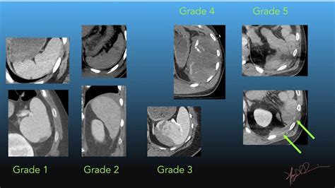 Aast Spleen Injury Scale 2018 Revision Uw Emergency Radiology