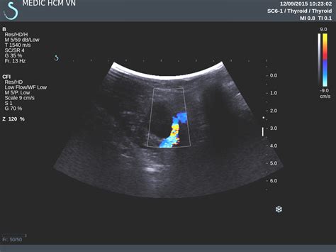 Vietnamese Medic Ultrasound Case Lung Mass Dr Phan Thanh H I