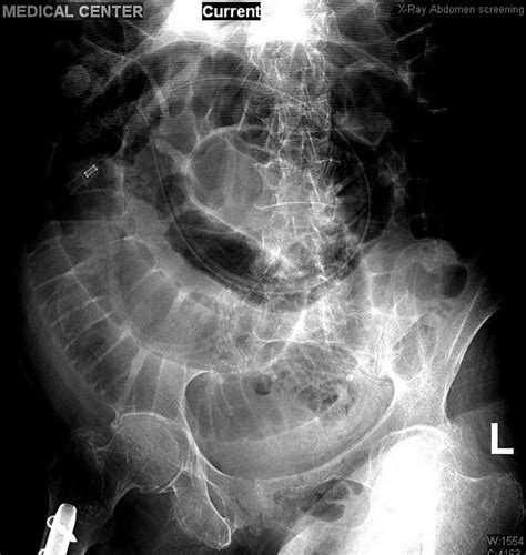Small Bowel Obstruction In A Woman With A Missing Percutaneous