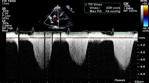 Cardio Oncology American College Of Cardiology