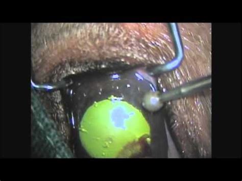 I'll debride all of the epithelium to within 1.5 mm of the limbus all the way. Corneal diamond Burr - YouTube
