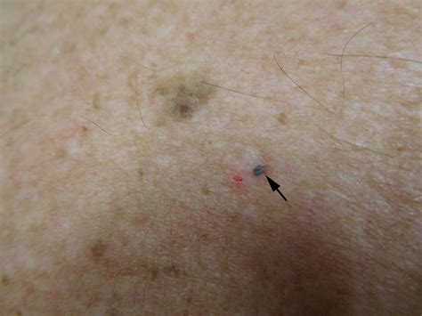 Cureus Red Dot Basal Cell Carcinoma Report Of Cases And Review Of