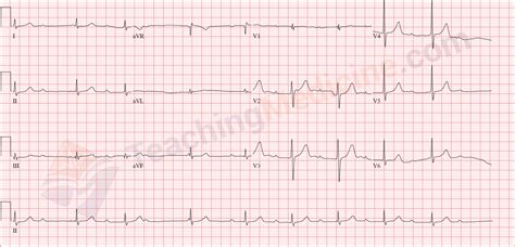 This results in the p waves (atrial depolarizations) being completely unrelated to the qrs complexes (ventricular depolarizations). QRS is narrow and again, not completely regular. The key ...