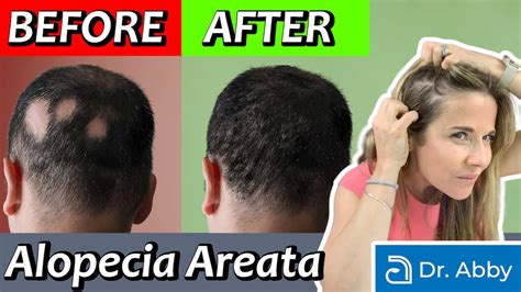 Alopecia Areata Causes And Treatment From A Dermatologist YouTube