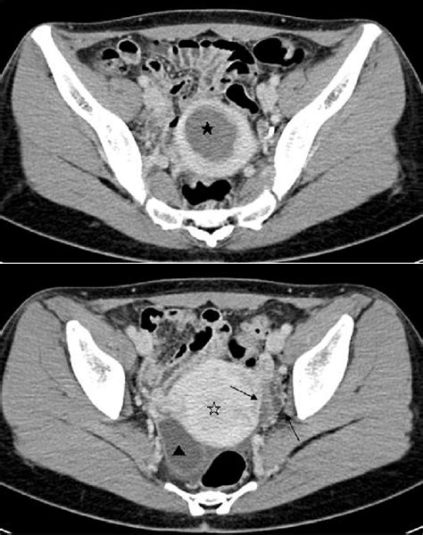 Radiological Findings A Pelvic CT Scan Demonstrated A 5 Cm Uterine