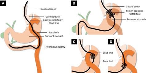 Gastric Access Temporary For Endoscopy Gate A Proposed Algorithm For Eus Directed