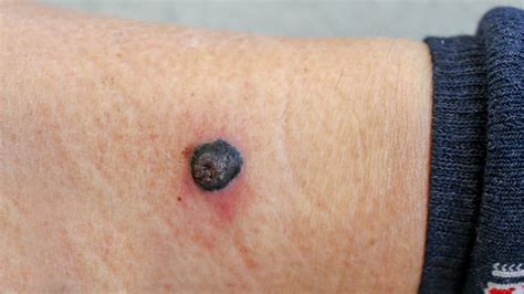 Mole Or Melanoma Heres How To Spot The Difference Laptrinhx News