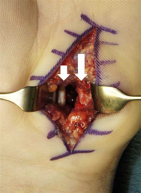 Excision Of Hook Of Hamate Fractures In Elite Baseball Players Surgical Technique And Return To