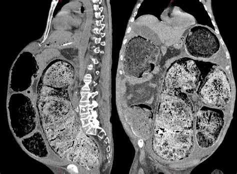 Abdominal Ct Scan Revealing A Severe Fecal Impaction Download