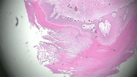 Cureus Pilar Cysts Of The Head And Neck A Case Report