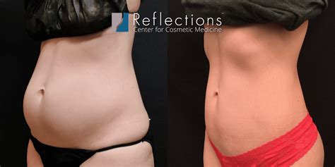 Laser Lipo 360 For Slim Toned Abs Love Handles Before After Photos
