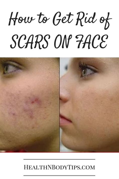 How To Get Rid Of Scars On Face Top 20 Home Remedies For Scars