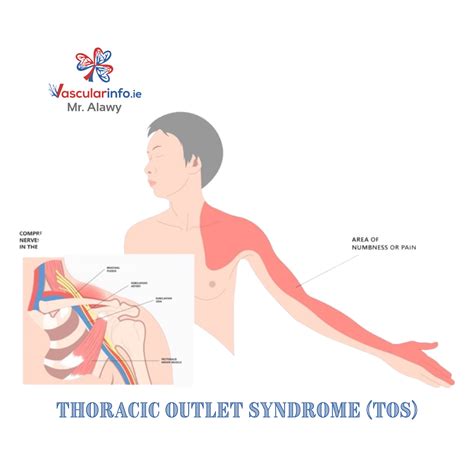 Thoracic Outlet Syndrome Vascular Info