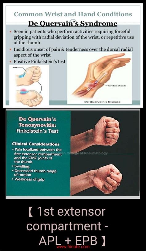 De Quervains Tenosynovitis Occupational Therapy Treatment Jamisonteator