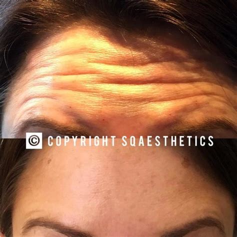 Wrinkles In Forehead Botox Before And After Pics 1 Facial