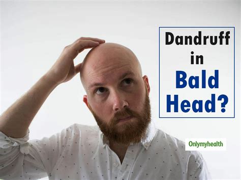 can bald people get dandruff onlymyhealth